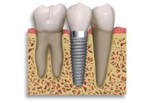 Làm Thế Nào Để Tiết Kiệm Khi Cấy Ghép Implant Nha Khoa