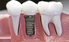 Cắm Implants